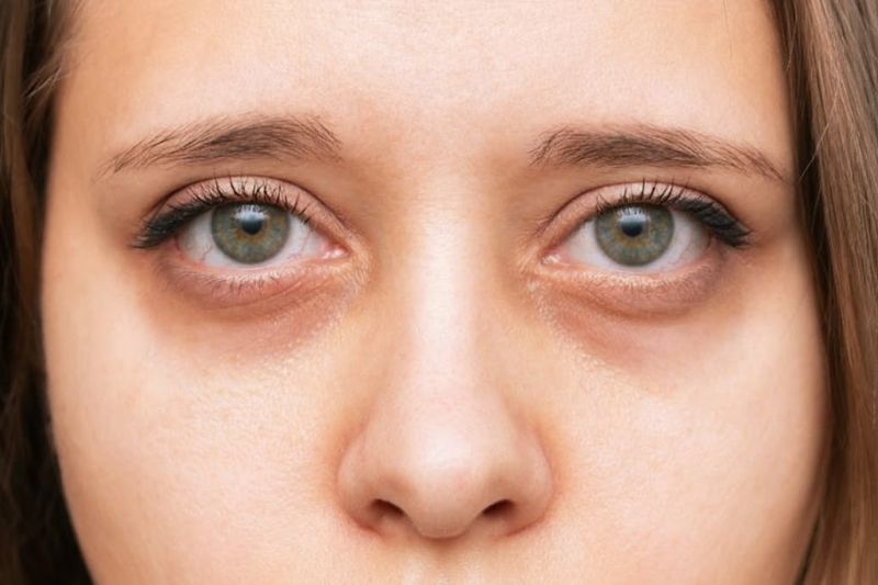 Close up of pale, tired eyes showing signs of low iron eyes and fatigue